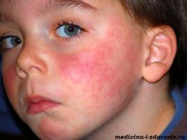 Немало неприятностей может принести так же и аллергия на солнечные лучи.