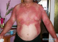 ожоги от борьщевика