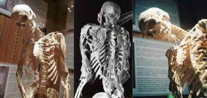 Фибродисплазию забыли, тоже диковенная хрень. Жутковатая.