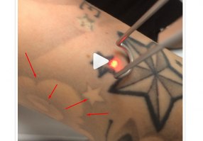 вроде остается наколка.не до конца удаляется .