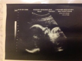 А вот фото моей ляльки за 2 месяца до рождения. Может, кому и трудно разглядеть, но вообще там лицо в профиль и ручка. И ни одной кости не видно. Вот это и есть УЗИ. А в посте либо рентген, либо фотошоп.