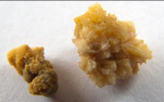 Камень Почечный