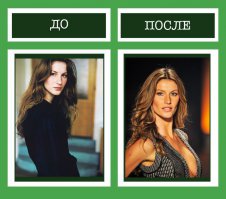 Написано "пластика кончика носа". Похоже за одно и сиськи нарастила :)