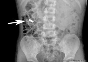 Взрослые !!! Не покупайте эту фигню ! 
Для маленьких Детей Смертельно ОПАСНО !
Если у Вас есть Дети, Племянники, Друзья с детьми - НЕ покупать ВООБЩЕ !!! Перитонит - это минимум. Хирурги будут резать, а Вы локти кусать и успокаивать рыдающих Женщин !
Автору ЖИРНЫЙ минус за такую рекламу без указания возраста +18 !