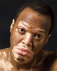 Почему "болезнь"? Просто пегая. К тому же, довольно симпатичная!
Да и она не уникальна.
У лошадей это обычное явление...