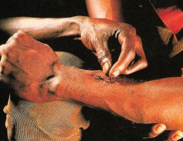 14. У муравья - клешни?!  Вообще-то это жвала. 
Помимо механического скрепления краев раны, воздействие оказывает муравьиная кислота как антисептик. Очень продвинутый метод в условиях первобытного образа жизни!