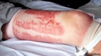 Чтобы сохранить юноше нормальную форму головы, врачи вставили ему в череп титановую пластину.
Отец Льюиса вспоминает тот страшный день так:

«По приезду в больницу, нам разрешили увидеть сына всего лишь на пару минут. Он был весь перебинтован, подключен к аппаратам и капельницам. Я взял его за руку и прошептал, чтобы он не сдавался».

Долгих 16 дней Льюис Годфри пребывал в коме, и врачи уже предупредили родителей, что в результате сильных повреждений мозга их сын вряд ли когда-то сможет ходить, а возможно, даже потеряет зрение и слух.

Тем не менее, парень умудрился и в третий раз удивить медиков. Вскоре после операции, он снова научился ходить, говорить, самостоятельно кушать. А спустя пять месяцев после трагедии Льюис уже даже строил планы по поводу возвращения на работу.
Чудо, произошедшее с Льюисом Годфри – это в том числе заслуга заботливого персонала медицинского центра Nottingham Queens. Здоровье Льюиса восстанавливали 6 врачей, 18 медсестер, 2 физиотерапевта, 2 профессиональных терапевта и другие медицинские работники. Кто-то из них «штопал» вены и артерии Льюиса, кто-то ремонтировал череп, кто-то – помогал снова встать на ноги.