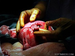 Снимок Майкла Клэнси "Рука надежды" был сделан 19 августа 1999 года. В тот день оперировали Джули Армас, которая была на 21-й неделе беременности. У ее малыша тоже был врожденный дефект позвоночника. Когда доктор закончил основную часть операции и собирался зашивать надрез в матке, малыш неожиданно высунул через него крохотную ручку и крепко схватил хирурга за палец как будто для того, чтобы поблагодарить его за дар жизни. Так происходящее на снимке описал его автор.

По данным хирурга Джозефа Брюнера, чьи кисти рук в перчатках запечатлены на фото, история Майкла Клэнси придуманная. Малыш и его мать находились под наркозом и не могли двигаться. Фото постановочное.
И все же, в отличие от всех остальных небылиц, мы не можем утверждать, что эта история чистой воды мистификация. После произошедшего во время операции фотограф Майкл Клэнси стал активным противником абортов и почти целиком посвятил популяризации своего снимка, чем и занимается по сей день.

Сложно поверить, чтобы взрослый человек был на протяжении многих лет столь одержим собственной мистификацией. Кроме того, им была выпущена книга Hand of Hope. The story behind the picture ("Рука надежды. История того, что осталось за кадром"), в которой он попытался доказать, что история снимка не выдумка. Хотя по-настоящему убедительных аргументов в пользу его истории в книге нет, версия автора выглядит правдоподобной.
Согласно Клэнси, действие наркоза, вероятно, уже закончилось к концу операции. Это и стало причиной того, что ребенок высунул руку из матки матери. Команде врачей не хотелось афишировать факт того, что из наркоза малыш вышел сразу после операции. Поэтому они и заявили, что снимок Клэнси не является репортажным.

В любом случае операция прошла успешно. В декабре 1999 года Джули родила здорового (и уже знаменитого) мальчика Самуэля. Сейчас ему 13 лет. Мистификация это или нет, но стоит заметить, что фотография Майкла Клэнси вызвала большой общественный резонанс.