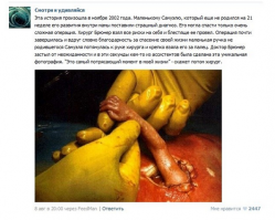 Взято с: 

На самом деле на этом фото запечатлена ручка Сары Свицер, снимок сделан 1 июля 1999 года. И главная деталь - фото является постановочным.

Автором этой работы стал известный фотограф Макс Агилера-Хеллвег, который работал по заданию популярного журнала Life (издавался до 2000 года). В том году хирурги-новаторы Джозеф Брюнер и Ноэль Тьюлипан провели в медицинском центре университета Вандербильта (Нашвилл, штат Теннесси, США) ряд успешных внутриутробных операций по устранению врожденного дефекта позвоночника у плода.

На одной из таких операций работал Макс Агилера-Хеллвег. Мама Сары была на 24-й неделе беременности. Операция прошла успешно.

Итоговое фото впечатляло, и в журнале Life собирались сделать из него обложку декабрьского номера журнала за 1999 год. Но этого не случилось, поскольку до выхода того номера широкую огласку получило другое фото, также сделанное в медицинском центре университета Вандербильта. Именно об этом фото авторы страницы "Смотри и удивляйся", видимо, и пытались рассказать.