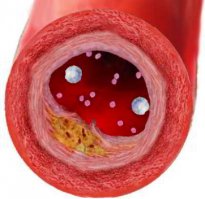 А это атеросклероз – состояние при котором липиды (жиры) откладываются в стенках, больших артерий и сосудах среднего диаметра, приводя к уменьшенному кровотоку в них или закупорке сосуда.