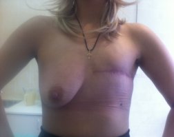 и чего, судя по всему хорошая клиника, есть деньги на импланты и прочее. 
Обычно всё без пластики вот так...