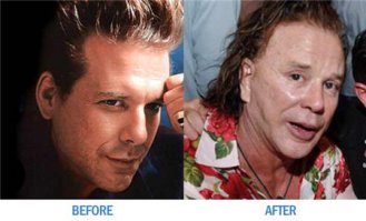 10 примеров неудачной пластики знаменитостей