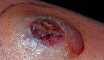 Последствия укуса паука-золотопряда...