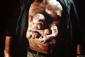 Девочка с сердцем снаружи поражает врачей