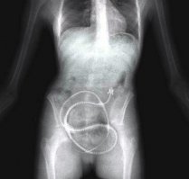 Аскариды все равно серьезней!