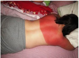 приличный ожог...представляю как болит