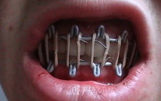 Шинирование при переломе челюсти