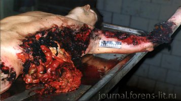 Повреждения при взрыве гранаты в кармане куртки..