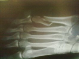 Я когда плюсневую кость сломала в травмпункте просто загипсовали после рентгена, сказали срастется, хотя даже медсестра-рентгенолог сказала, что операцию делать надо. Ну да я только порадовалась, раз врач сказал что срастется))) В итоге месяц ползала в гипсе, пока не попала на проверку к другому врачу-травматологу, который только глянув снимки сразу же отправил в больничку на консультацию-операцию (это был четвертый врач, который меня за месяц смотрел). В итоге в пятницу положили, и через неделю же и выписали. Сейчас бегаю уже радостно, правда, с пластиной и болтами в ноге)) Хорошо, что еще нормальные врачи попадаются и внимательные и профессиональные)))