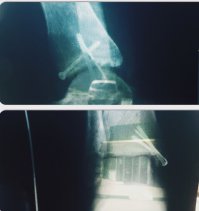 Упал с мотика,дежурный врач в травмпункте сказал,что ничего страшного,лед приложи и пройдет. Как итог перелом лодыжки со смещением.