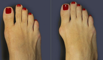 Ага, склейте пальцы, измените точку опоры и центр тяжести ступни, потом получите вот что, и это в лучшем случае. Тесная или обувь с неудобной колодкой - результат тот же