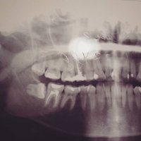 Вот ведь сволочь какая... за каким лешим вообще коренные зубы лезут куда попало...