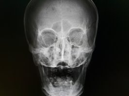 А вот так выглядит череп старика, у которого не осталось своих зубов. Снято лично на рабочем месте, очень смешной показалась эта "улыбка".