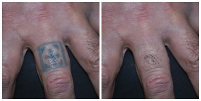 Поискал по точнее, нашел! Процедура удаления 1 cm² — 3 € (1 сеанс) системой - Rejuvi. В среднем, чтобы удалить полностью татушку, нужно от 2 до 8 сеансов. Число сеансов зависит  от цвета татушки и глубины краски.