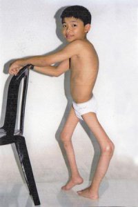 Аппарат "Железные легкие" не имеет никакого отношения к полиомиелиту!  Вот, ребёнок с полиомиелитом.