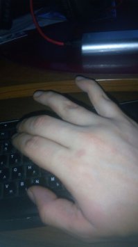 на меня как то напал упырь один, хотел ограбить, долго сперва бычил, я его несколько раз отодвинул и сказал, что спешу и ниче не отдам, в очередной раз, когда я собрался уходить, мне в живот полетел ножик, который я умудрился схватить правой рукой и дернув за нож (я сразу не понял, за что я поймал), чтобы ударить его коленом в перерезал себе сухожилия на мизинце и безымянном пальце, средний палец только надрезал, но царапина. Справился я с ним без кулаков (кулак уже не сгибался на руке, пальцы торчком) локтями отмахался, держа разбойника за воротник левой и убежал, пока тот потерялся и сидел на коленях. Вызвал скорую по дороге, приехали, отвезли в травмпункт. Там мне зашивал пальцы бухой хирург, без анестезии и с сигаретой в зубах (в Балашихе дело было). Далее травмпункт по месту жительства, там направили в больницу на Бауманской где-то, по-моему 6ая, не помню... В больнице пластический хирург сказала, что на операционном столе посмотрим, если сухожилия уехали далеко, то будем с мезинца ноги тебе вырезать и в руку "вживлять". Повезло, без ноги обошлось. Разрабатывал пальцы целый год, первые 4 месяца нужно было каждые 2 часа перематывать повязку, фиксируя пальцы в положении "прямо", потом в положении  кулака, на ночь в кулак. С утра после этого кулака разминка пальцев, выпрямляем и чувствуем как внутри пальцев идет такой хруст, как буд-то куриную ножку от жареной курицы отрываешь, такое же ощущение. Вначале первый месяц дикая боль, как будто я ломаю палец, но я ОРАЛ, но делал. Потом остался только хруст, который тошнотворил тех, кто был рядом. В общем результата я добился через год. Пальцы правда кривые, но работаю и держат. Безымянный - не сгибается последняя фаланга только, но хирург предупреждала, что скорее всего так и будет, так у всех.