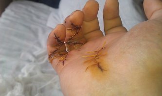 на меня как то напал упырь один, хотел ограбить, долго сперва бычил, я его несколько раз отодвинул и сказал, что спешу и ниче не отдам, в очередной раз, когда я собрался уходить, мне в живот полетел ножик, который я умудрился схватить правой рукой и дернув за нож (я сразу не понял, за что я поймал), чтобы ударить его коленом в перерезал себе сухожилия на мизинце и безымянном пальце, средний палец только надрезал, но царапина. Справился я с ним без кулаков (кулак уже не сгибался на руке, пальцы торчком) локтями отмахался, держа разбойника за воротник левой и убежал, пока тот потерялся и сидел на коленях. Вызвал скорую по дороге, приехали, отвезли в травмпункт. Там мне зашивал пальцы бухой хирург, без анестезии и с сигаретой в зубах (в Балашихе дело было). Далее травмпункт по месту жительства, там направили в больницу на Бауманской где-то, по-моему 6ая, не помню... В больнице пластический хирург сказала, что на операционном столе посмотрим, если сухожилия уехали далеко, то будем с мезинца ноги тебе вырезать и в руку "вживлять". Повезло, без ноги обошлось. Разрабатывал пальцы целый год, первые 4 месяца нужно было каждые 2 часа перематывать повязку, фиксируя пальцы в положении "прямо", потом в положении  кулака, на ночь в кулак. С утра после этого кулака разминка пальцев, выпрямляем и чувствуем как внутри пальцев идет такой хруст, как буд-то куриную ножку от жареной курицы отрываешь, такое же ощущение. Вначале первый месяц дикая боль, как будто я ломаю палец, но я ОРАЛ, но делал. Потом остался только хруст, который тошнотворил тех, кто был рядом. В общем результата я добился через год. Пальцы правда кривые, но работаю и держат. Безымянный - не сгибается последняя фаланга только, но хирург предупреждала, что скорее всего так и будет, так у всех.