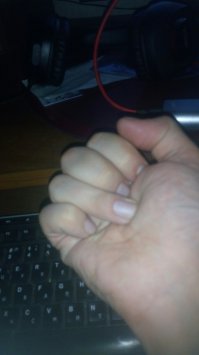 на меня как то напал упырь один, хотел ограбить, долго сперва бычил, я его несколько раз отодвинул и сказал, что спешу и ниче не отдам, в очередной раз, когда я собрался уходить, мне в живот полетел ножик, который я умудрился схватить правой рукой и дернув за нож (я сразу не понял, за что я поймал), чтобы ударить его коленом в перерезал себе сухожилия на мизинце и безымянном пальце, средний палец только надрезал, но царапина. Справился я с ним без кулаков (кулак уже не сгибался на руке, пальцы торчком) локтями отмахался, держа разбойника за воротник левой и убежал, пока тот потерялся и сидел на коленях. Вызвал скорую по дороге, приехали, отвезли в травмпункт. Там мне зашивал пальцы бухой хирург, без анестезии и с сигаретой в зубах (в Балашихе дело было). Далее травмпункт по месту жительства, там направили в больницу на Бауманской где-то, по-моему 6ая, не помню... В больнице пластический хирург сказала, что на операционном столе посмотрим, если сухожилия уехали далеко, то будем с мезинца ноги тебе вырезать и в руку "вживлять". Повезло, без ноги обошлось. Разрабатывал пальцы целый год, первые 4 месяца нужно было каждые 2 часа перематывать повязку, фиксируя пальцы в положении "прямо", потом в положении  кулака, на ночь в кулак. С утра после этого кулака разминка пальцев, выпрямляем и чувствуем как внутри пальцев идет такой хруст, как буд-то куриную ножку от жареной курицы отрываешь, такое же ощущение. Вначале первый месяц дикая боль, как будто я ломаю палец, но я ОРАЛ, но делал. Потом остался только хруст, который тошнотворил тех, кто был рядом. В общем результата я добился через год. Пальцы правда кривые, но работаю и держат. Безымянный - не сгибается последняя фаланга только, но хирург предупреждала, что скорее всего так и будет, так у всех.