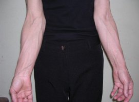 Варикоз только на ногах бывает по вашему?)ДА тут одни эксперты я смотрю. А тут вы разницу видите? Ее тут нет ибо варикоз на руках это не только бугрящиеся сквозь ко жный покров вены в определенных местах.