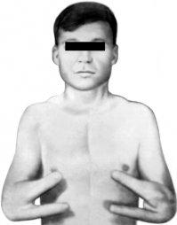 Наверное имелась ввиду "рука Крукенберга"