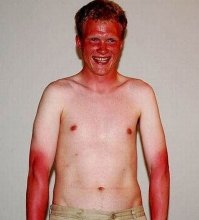 14 солнечных ожогов, которые настолько же смешные, насколько они болезненные