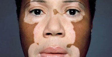 Витилиго у него было, погугли.