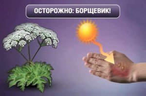 Пользователи Твиттера прикалываются над фото девушки, которой в глаза попал ядовитый плющ