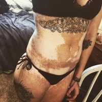 У этой, похоже, не витилиго, а потертости...