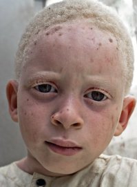 а кто вам сказал,Что у альбиносов ВСЕГДА красные глаза? загуглите и будете удивлены,как вы ошибались.