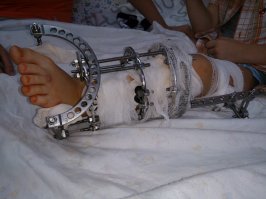 С чего они становятся хрупкими? Просто нарастает костная мозоль и если в этом месте сломать ногу она уже не срастется, нужно ставить штифт. А крепость кости зависит от питания, а не от вытягивания ее. Откуда известно? Вот мой племяш и ему тянут кость по показаниям, разница между ногами такая, что если не тянуть, то будет кривой хромой горбун.