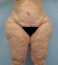 Будете много жрать, будет такое: