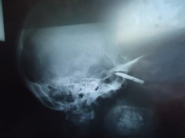 Я для этого и спросил, есть ли томограф другого принципа воздействия? Потому как внешне это был именно МРТ. Ну и если вы врач, то оцените степень опасности для меня проведения для меня лично МРТ по фотографиям. На консилиум приезжали лицевые хирурги из Питера и из Москвы.Наверное они не дураки. Хотя я Вас понимаю. Некоторые вещи не укладываются в рамки нормативов. Просто по другому нельзя.