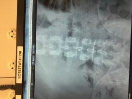 Так себе история, драйва маловато. Вот у меня пациент то бритвы проглотят, то яблоко в ж@пу засунут, то новогодний шарик во влагалище. Вот бритвы, очень красиво.