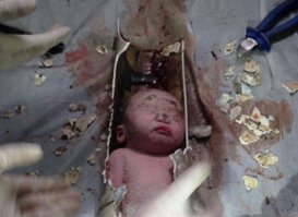 Спасатели извлекают из отрезка канализационный трубы застрявшего в ней новорожденного мальчика. Младенец был спущен в канализацию в многоквартирном жилом доме в Цзиньхуа, провинция Чжэцзян, Китай.Мальчик был спасен.