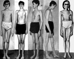 может, у Фелпса гибкие и длинные конечности, но у него не синдром Марфана. Вряд ли. Это очень тяжелое генетическое заболевание, при котором едва ли человек может вообще заниматься физкультурой, не говоря уж о проф.спорте.