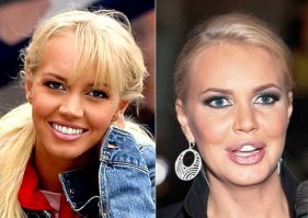 Не прокатило: звезды, которых изуродовала неуемная пластика