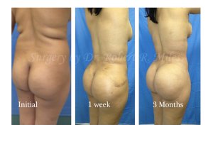 Первое фото - бразильская подтяжка. Второе показывает естественное распределение жира и как оно убирается хир. путем. Большая попа и отсутствие галифе возможны только у женщин, которые занимаются спортом. Но у них большая попа за счет мышечной массы, а не жира, как у Кардащан.