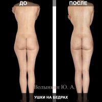 Первое фото - бразильская подтяжка. Второе показывает естественное распределение жира и как оно убирается хир. путем. Большая попа и отсутствие галифе возможны только у женщин, которые занимаются спортом. Но у них большая попа за счет мышечной массы, а не жира, как у Кардащан.