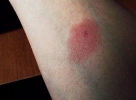 1 - на фото комар а не москит. Москиты они типа мошки и в отличии от комара не прокалывают кожу, а выгрызают отверстие. Их укусы выглядят как "пуговка" манту.