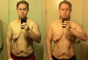 а под майкой так? 
вот всегда было интересно, люди которые резко похудели на 100500 кило, как борются с последствиями такого похудения? 
как следствие размышлений на тему. вот человек, допустим, толстый. стесняется своей полноты, одежды размера 65XXL, не может раздеться на пляже, перед телочками и т.д. 
и вот к какой-то продолжительный момент времени у него получается похудеть. И теперь он весит вменяемые 70-80 килограмм. Фоткается в инстаграмчик, показывает свои старые портки, которые больше похожи на чехол для машины. Но под майкой – вот такое безобразие. И проблема остается – на пляже не раздеться, перед телочками не покрасоваться.
Нет, не то, чтобы я стебался… я очень уважаю людей, которые смогли изменить себя. Уверен, что физическому состоянию тела стало гораздо лучше! Но морально – так же осталось ограничение.